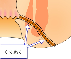 くりぬき法