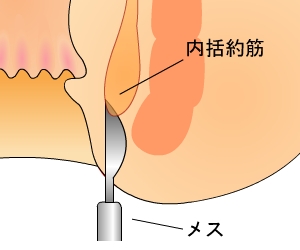 切開術