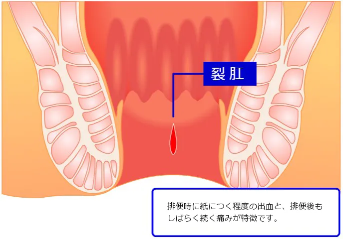 裂肛