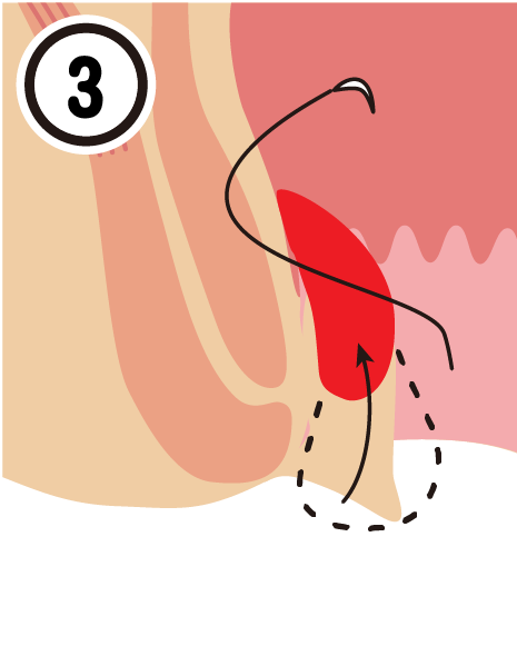 ACL3
