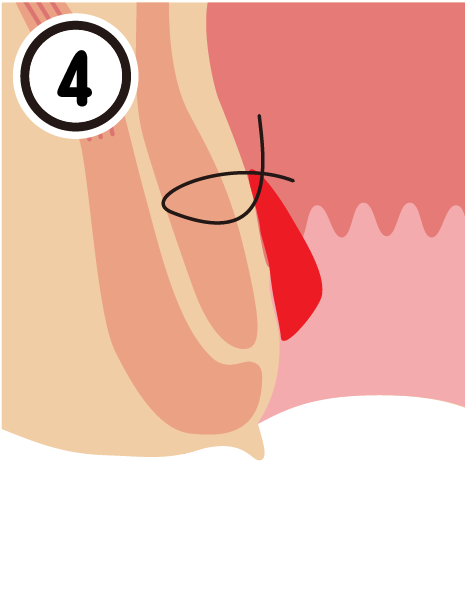 ACL4