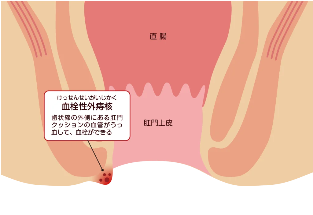 血栓性外痔核