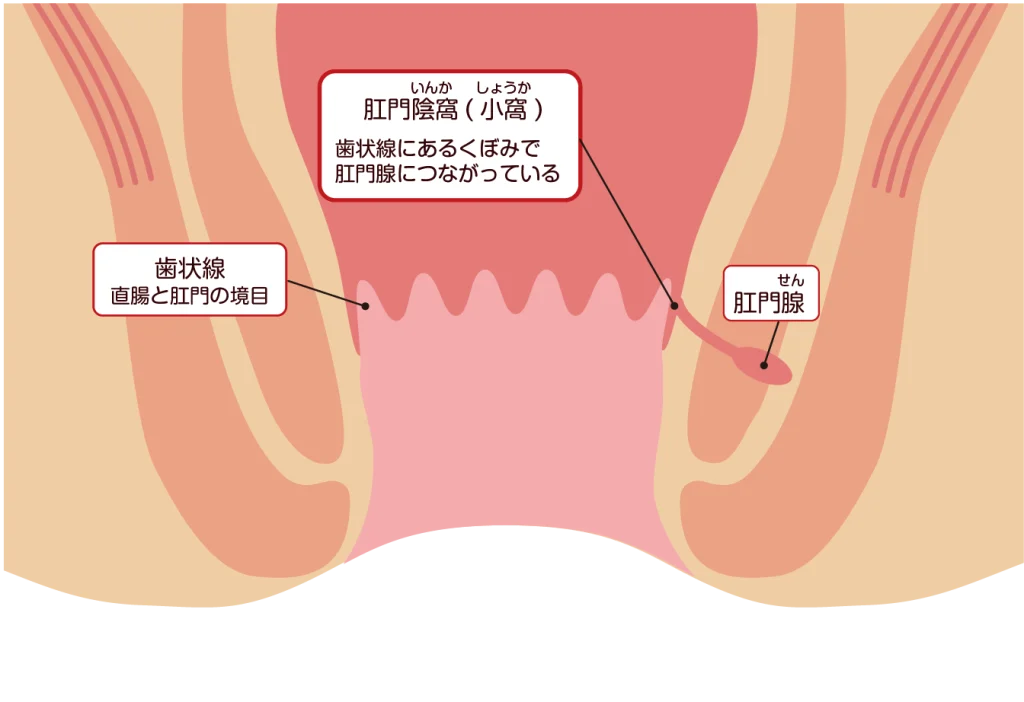 痔瘻1段階