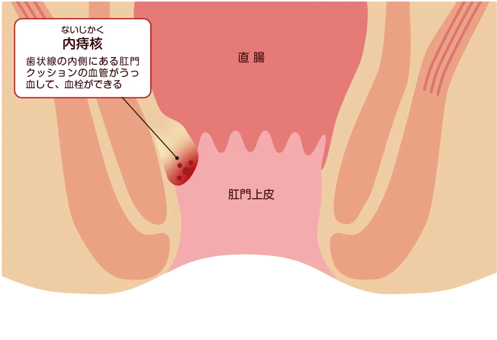 内痔核