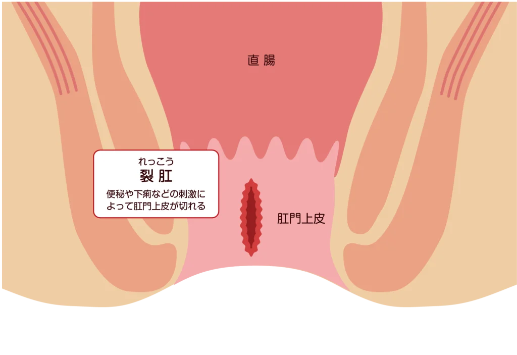 裂肛（切れ痔）